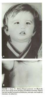 Möbius and Möbius-Like Syndromes (TTV-OFM, OMLH)