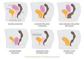 Pelvic Organ Prolapse Pop Is Defined As A Relaxation Or Lack Of Support Via The Fascial And Ligam Pelvic Organ Prolapse Pelvic Floor Pelvic Floor Dysfunction