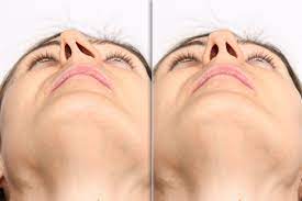 We did not find results for: What Happens If You Don T Fix A Deviated Septum Westside Head Neck