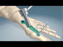 Youtube Bunion Surgery Severe Arthritis Foot Injury