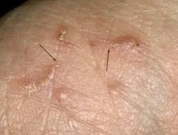 You'll need to repeat the treatment 1 week later. Scabies Dermnet Nz