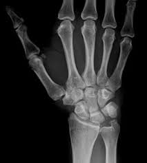 Ulnar Impaction Syndrome: A Case Series Investigating The Appropriate  Diagnosis, Management, And Post-Operative Considerations