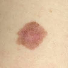 These photos show what melanoma skin cancer looks like and how to spot a cancerous mole. Melanoma Pictures Example Pictures Of Melanoma Symptoms