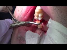 Having a tooth pulled in adulthood is sometimes necessary. Physics Forceps Upper Molar Tooth Extraction Cytoplast Barrier Grafting Youtube