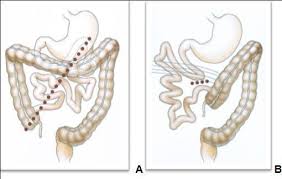 Image result for Intestinal Malrotation