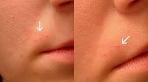 While many systems don't allow for facial hair removal, the no!no! No No Hair Removal Reviews Galhairs