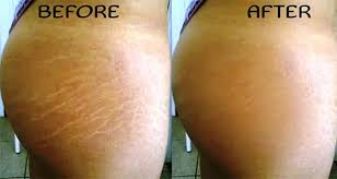 Bio Oil White Stretch Marks Before And After Stretch Marks Are Lesions That Appear On The Skin Especially In The Abdomen Hips And Breasts Usual Stretch Marks Oil Skin Care Routine Bio Oil Stretch Marks