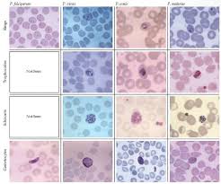 Malaria is a mosquito borne disease caused by different varieties of malarial parasite. Microscopy Microscopy Morphologic Analysis Continues To Be The Gold Standard For Malaria Diagnosis Parasites May Be Visualized On Bot