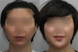 Image result for Micrognathia