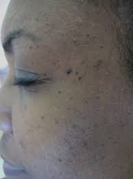 What are the characteristics of intradermal nevi. The Most Common Skin Lesions Benign With Pictures