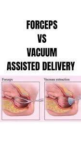Image result for Forceps Assisted Delivery