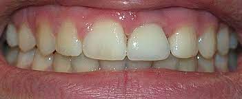 7 Weird Things Your Teeth Are Trying To Tell You Massie Dental