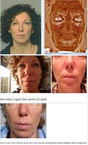 Anja test (deel 3): Vitamine A-zuur versus hannah Experience behandelingen