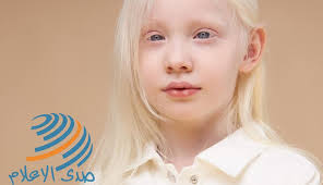 المهق البرص أسباب وأعراض وطرق علاج صدى الإعلام 2020 07 08
