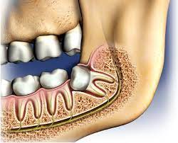 Then we will get into how the removal procedure works, how much it costs, and how to schedule your own if necessary. How Much Do Teeth Pulled Cost Uk