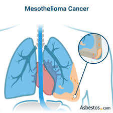 Asbestos is the name of a group of minerals with thin fibers. Asbestos Cancer Mesothelioma Lung Cancer Other Cancers