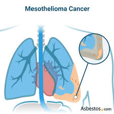 lung cancer may also be caused by smoking. Asbestos Cancer Mesothelioma Lung Cancer Other Cancers
