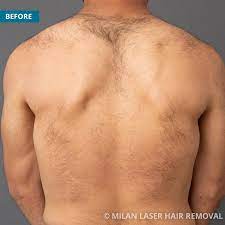 Laser back hair removal is the proven method for getting rid of unwanted back hair quickly and effectively. Men S Before After Photos Of Laser Hair Removal Milan Laser In Toledo Oh