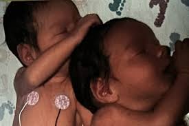 Twins forever grateful to NICU nurse who cared for them