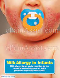 The few babies with lactose intolerance will usually fare much better on a. Milk Allergy In Infants Causes Symptoms Tests Treatment