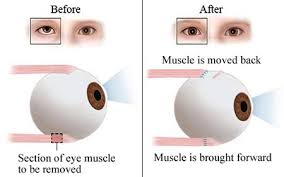 Lazy Eye Surgery Top Eye Specialist Best Rated Nyc Ophthalmologist