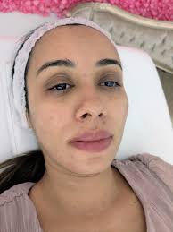Microneedling with LED light therapy can be a beneficial combination for  managing acne and acne scarring stimulates collagen production, helping to  improve skin texture and reduce the appearance of scars 😍 models