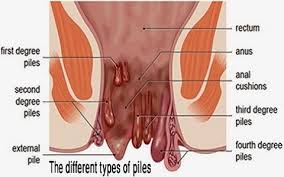 Pile or piles may refer to: Haemorrhoids Commonly Known As Piles Is A Very Common Ailment It Classically Presents As Bleeding From Hemorrhoids Treatment Hemorrhoid Remedies Hemorrhoids