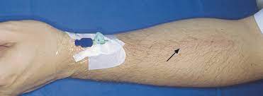 Thrombophlebitis Venenentzundungen Eref Thieme