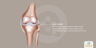 Penyebab sakit lutut dapat karena masalah dengan sendi lutut sendiri, atau penyebab lutut sakit tingkat keparahan sakit di lutut sangat bervariasi. Lutut Keseleo Tanda Dan Gejala Penyebab Cara Mengobati Cara Mencegah