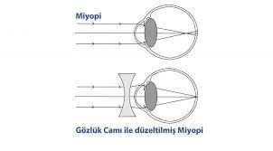 miyopi nedenleri ve tedavisi doc dr fatih cakir gundogan kayseri