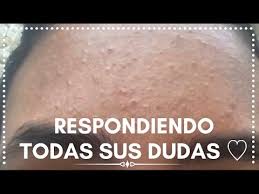 Como Eliminar Los Granos De La Frente 2 Danola Youtube