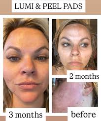 Does panoxyl help with acne and oil control?