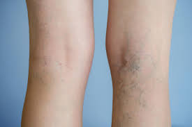 Varicose Veins Mydr Com Au