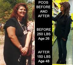 Pcos Before And After Yes You Can Beat Pcos But You Have To Be Strict With Your Diet And Medication There S No Other Way Pcos Pcos Diet Pcos Diet Recipes