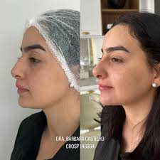 Nariz + mento (queixo) + olheira 💉🤍 Um antes e depois cheio de  naturalidade, elegância e delicadeza 😮‍💨 DRA. BÁRBARA CASTILHO CROSP  148964