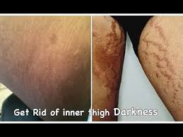 How To Get Rid Of Private Area Inner Thigh Darkness Easy N Fast Youtube Inner Thigh Darkness Inner Thigh Thighs