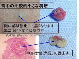 粉瘤 ふんりゅう 表皮嚢腫 ひょうひのうしゅ アテローマ アテローム 医療法人恵生会 長瀬内科医院 アテローム ふんりゅう スキンケア