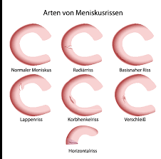Denn leider kommt dies bei fußballern sehr häufig vor. Spezialist Meniskusriss Priv Doz Dr Katja Emmanuel
