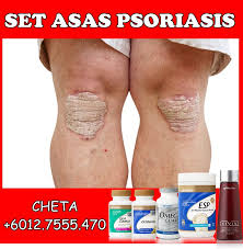 Ketidakseimbangan sistem kekebalan tubuh memainkan peranan dalam perkembangan keadaan ini dan faktor pencetus. Cara Ubat Psoriasis Berubat A