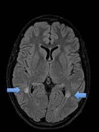 Wenn die multiple sklerose unter der therapie längere zeit stabil ist (zum beispiel keine schübe mehr, kein fortschreiten der ms im mrt erkennbar), können arzt und patient gemeinsam. Multiple Sklerose Radiologiezentrum Mannheim