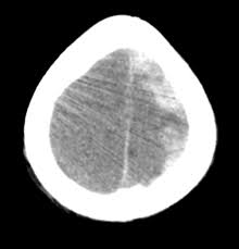 Subdural Hematoma Cancer Therapy Advisor
