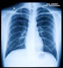 Image result for Chest XRay