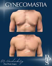 Image result for Gynecomastia