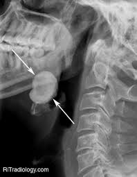 Image result for Sialolithiasis