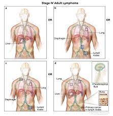 Lymphoma Cdc