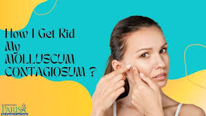 Get Molluscum Contagiosum Treatment from Dr. Ashima Goel