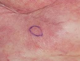Image result for Erysipeloid