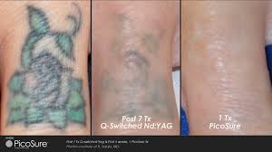 Hubert studied medicine at cornell university and is a practising dermatologist in the usa. Laser Tattoo Removal With Picosure Laser Treatment Epilium Skin