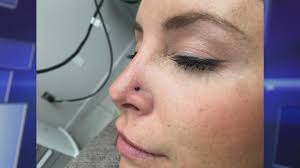 The pimple also may go away and come right back in the same spot, and it won't have pus when you squeeze it, wattenberg noted. This Woman S Pimple Turned Out To Be Skin Cancer The Doctors Tv Show