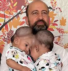 Conjoined sisters separated by surgery